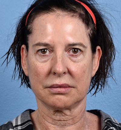 Hidden Patients Before & After Gallery - Patient 345137 - Image 1