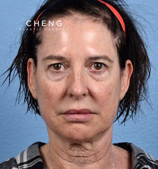 Hidden Patients Before & After Gallery - Patient 345137 - Image 1
