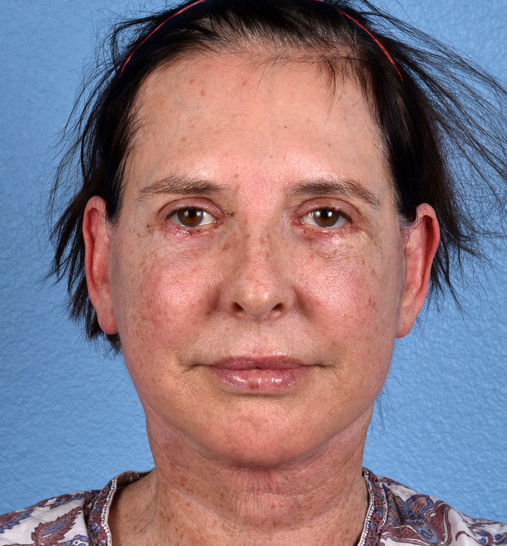 Hidden Patients Before & After Gallery - Patient 345137 - Image 2