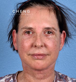 Hidden Patients Before & After Gallery - Patient 345137 - Image 2