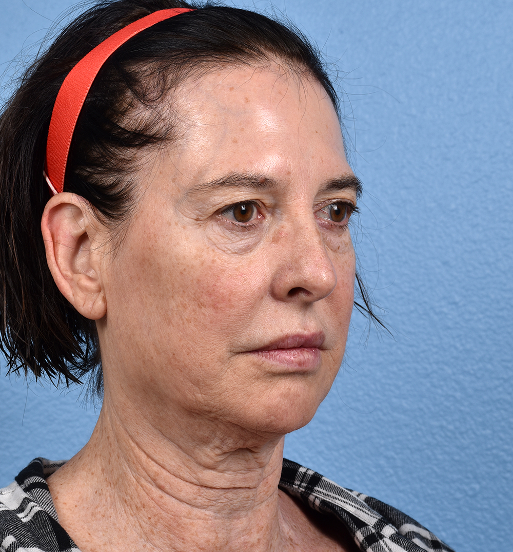 Hidden Patients Before & After Gallery - Patient 345137 - Image 3