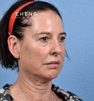 Hidden Patients Before & After Gallery - Patient 345137 - Image 3