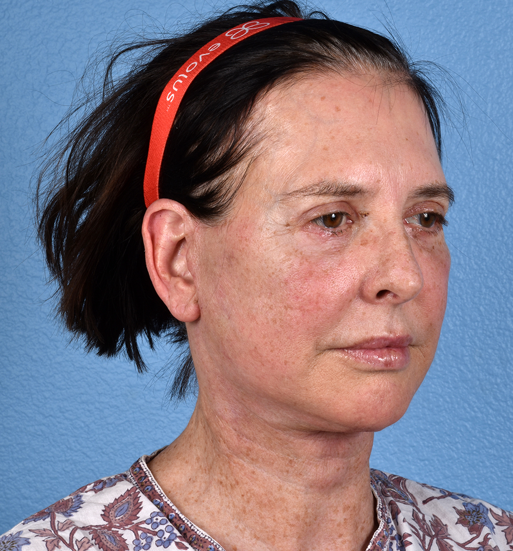 Hidden Patients Before & After Gallery - Patient 345137 - Image 4