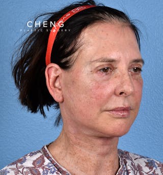 Hidden Patients Before & After Gallery - Patient 345137 - Image 4