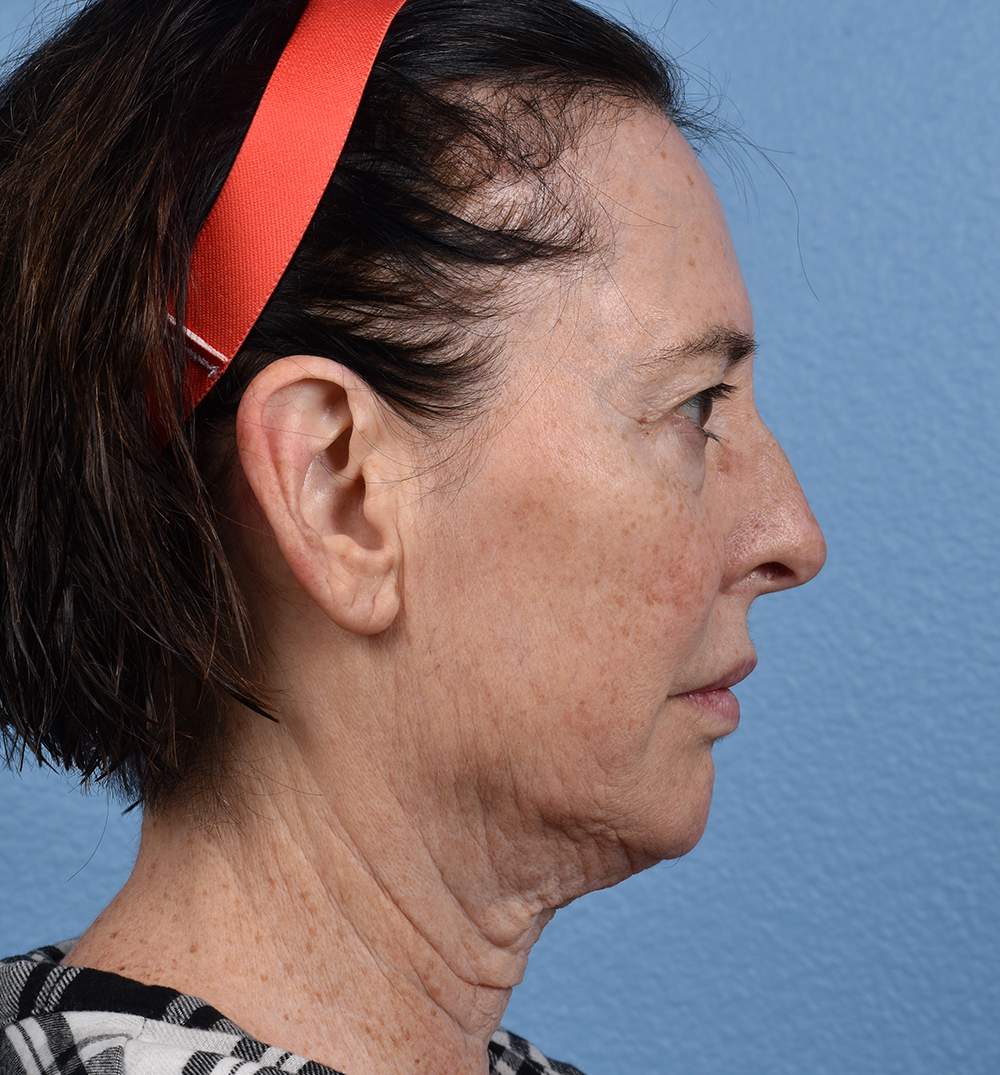 Hidden Patients Before & After Gallery - Patient 345137 - Image 5