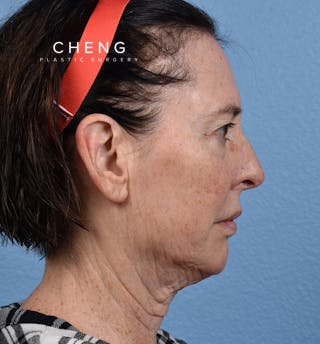 Hidden Patients Before & After Gallery - Patient 345137 - Image 5