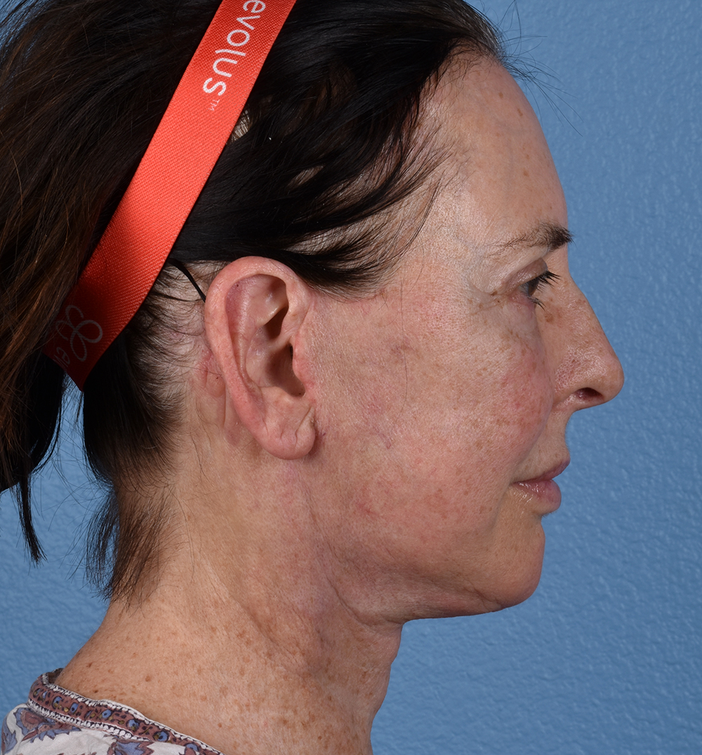 Hidden Patients Before & After Gallery - Patient 345137 - Image 6