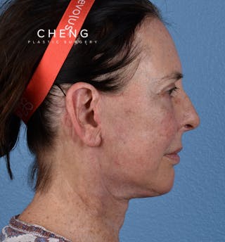 Hidden Patients Before & After Gallery - Patient 345137 - Image 6