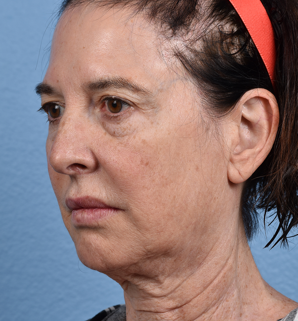 Hidden Patients Before & After Gallery - Patient 345137 - Image 7