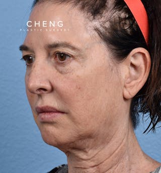 Hidden Patients Before & After Gallery - Patient 345137 - Image 7