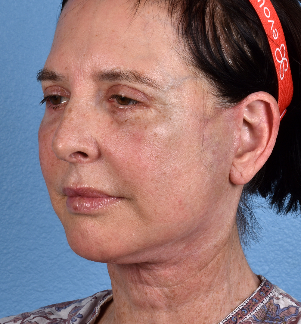 Hidden Patients Before & After Gallery - Patient 345137 - Image 8