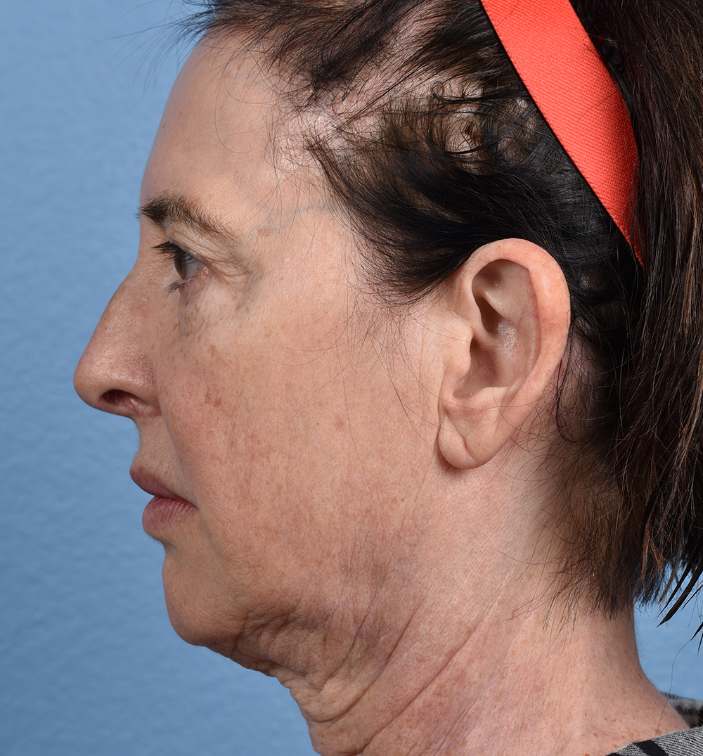 Hidden Patients Before & After Gallery - Patient 345137 - Image 9