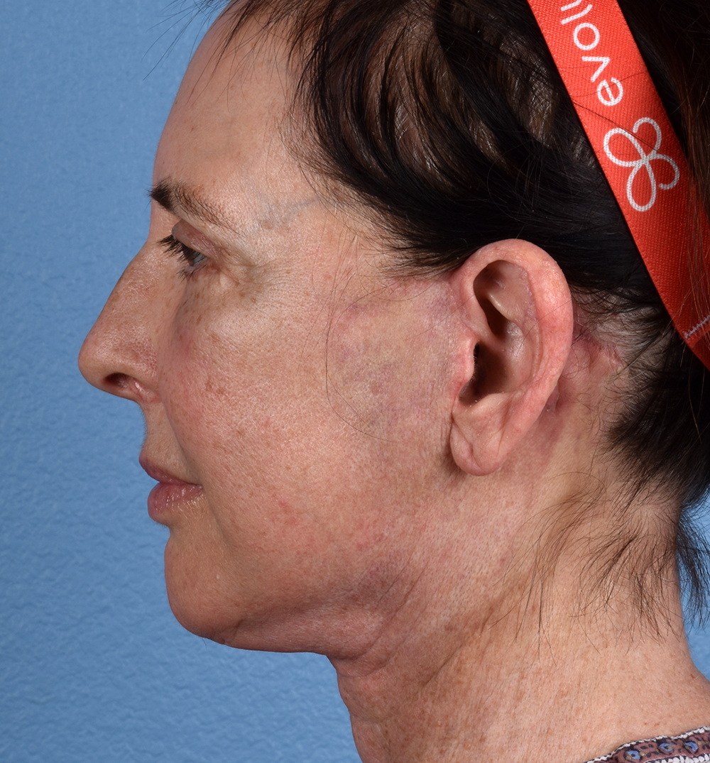 Hidden Patients Before & After Gallery - Patient 345137 - Image 10