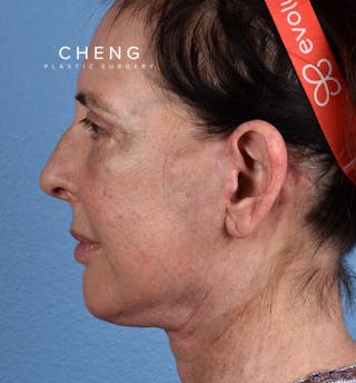 Hidden Patients Before & After Gallery - Patient 345137 - Image 10