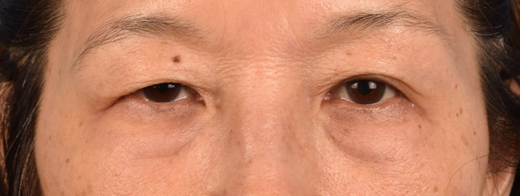 Brow Lift Before & After Gallery - Patient 542005 - Image 1