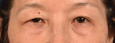 Blepharoplasty Before & After Gallery - Patient 268032 - Image 1
