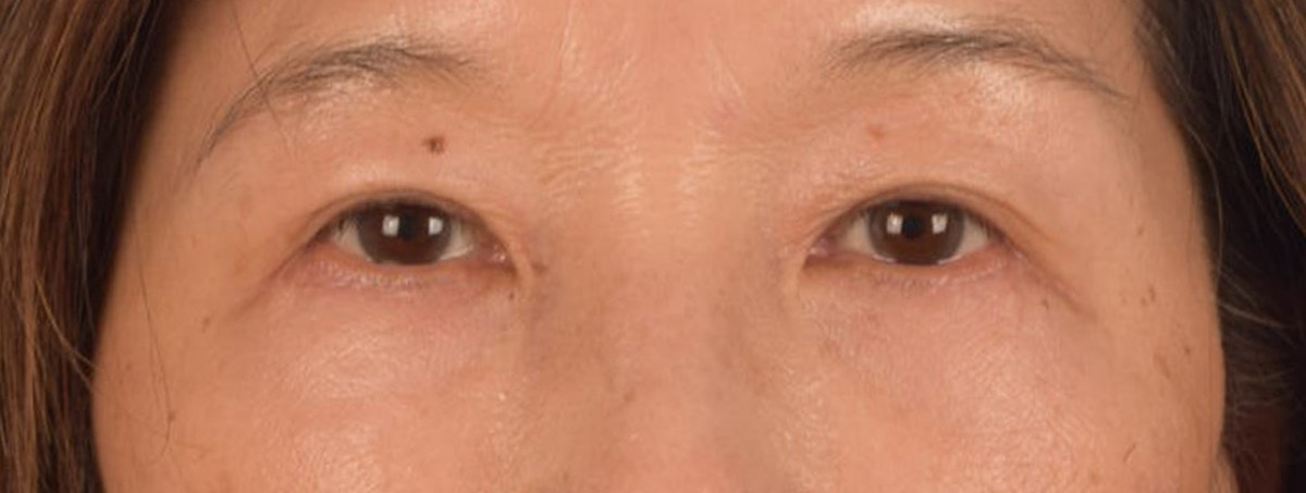 Blepharoplasty Before & After Gallery - Patient 268032 - Image 2