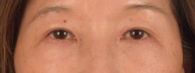 Blepharoplasty Before & After Gallery - Patient 268032 - Image 2