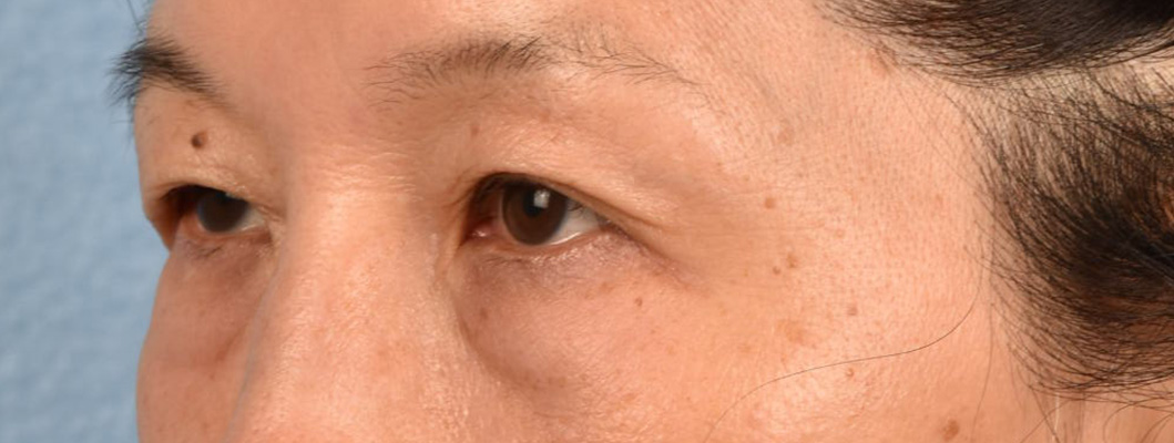 Brow Lift Before & After Gallery - Patient 542005 - Image 3