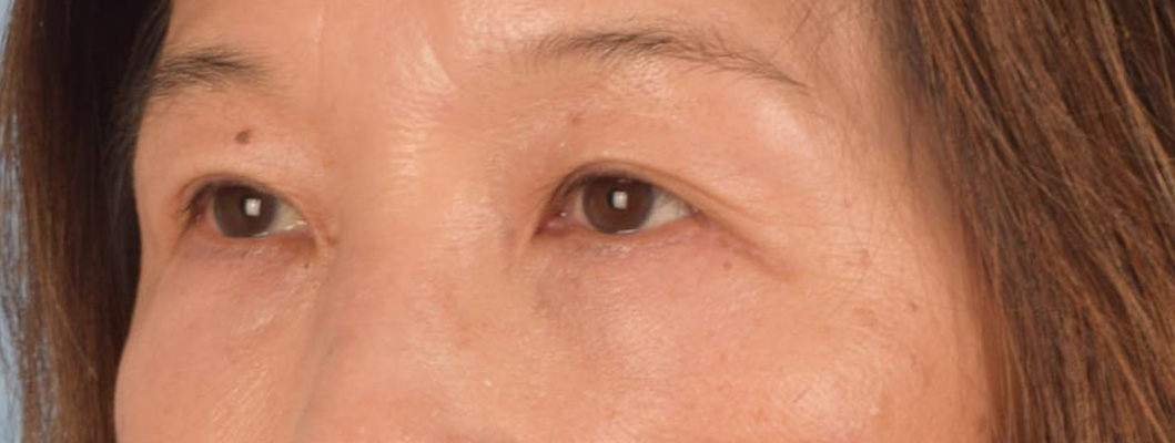 Brow Lift Before & After Gallery - Patient 542005 - Image 4