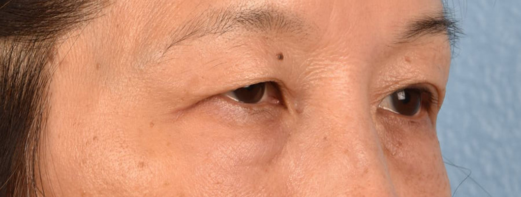 Brow Lift Before & After Gallery - Patient 542005 - Image 5