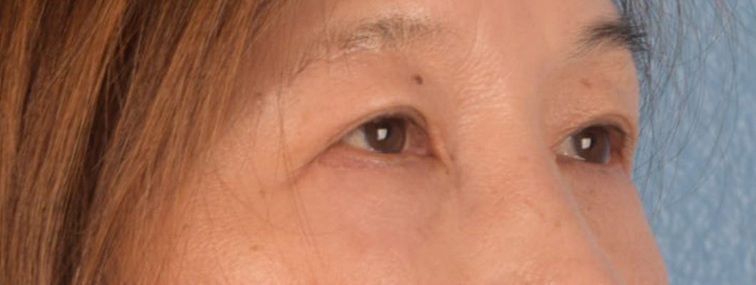 Brow Lift Before & After Gallery - Patient 542005 - Image 6