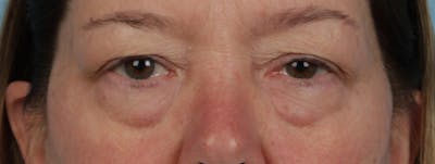 Pigment Laser Before & After Gallery - Patient 407755 - Image 1