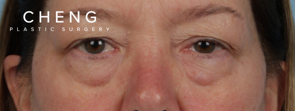 Hidden Patients Before & After Gallery - Patient 385354 - Image 1