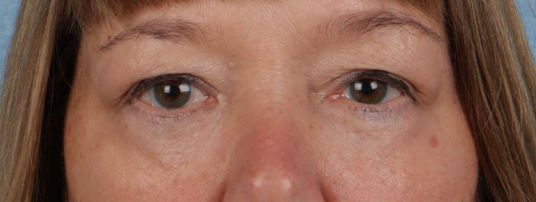 Hidden Patients Before & After Gallery - Patient 385354 - Image 2