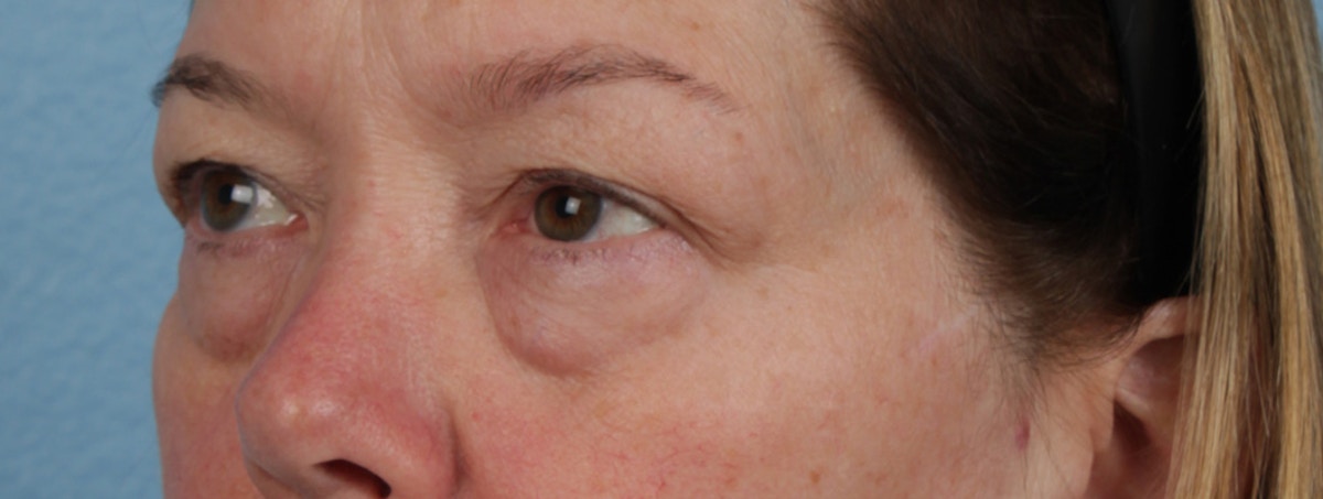 Pigment Laser Before & After Gallery - Patient 407755 - Image 3