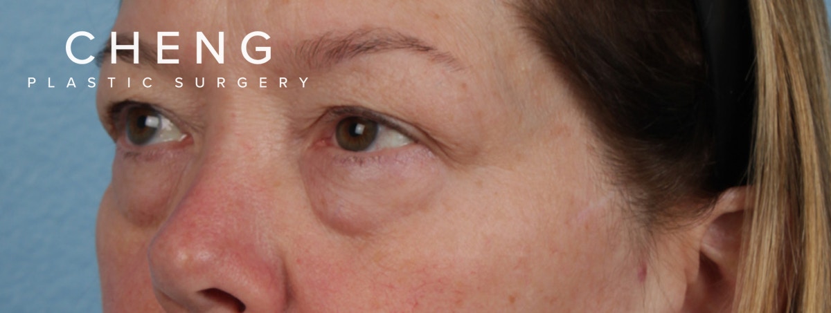 Hidden Patients Before & After Gallery - Patient 385354 - Image 3