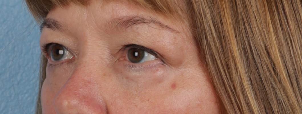 Hidden Patients Before & After Gallery - Patient 385354 - Image 4