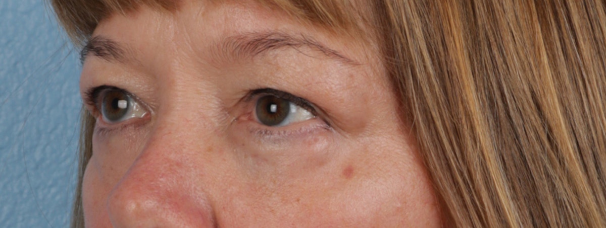 Pigment Laser Before & After Gallery - Patient 407755 - Image 4