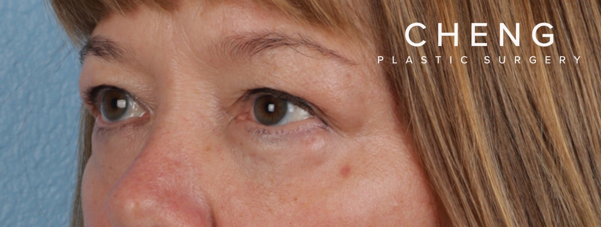 Hidden Patients Before & After Gallery - Patient 385354 - Image 4