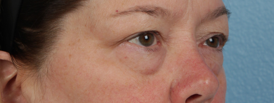 Hidden Patients Before & After Gallery - Patient 385354 - Image 5