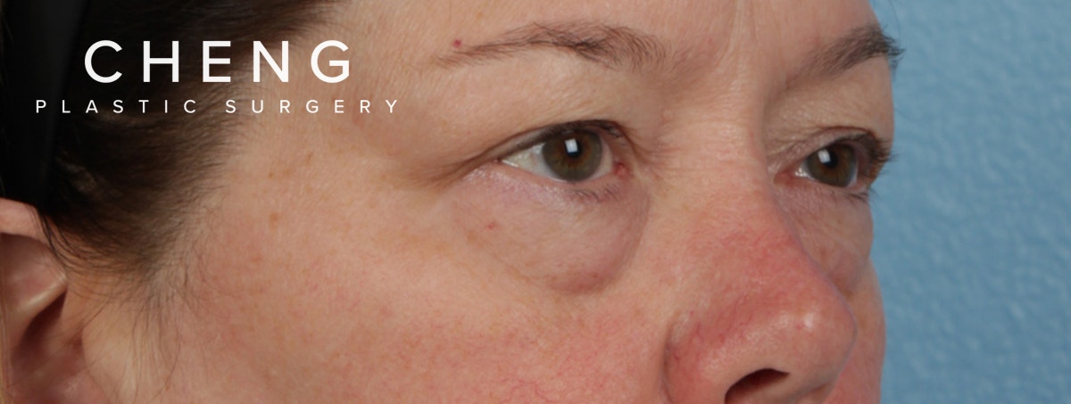 Hidden Patients Before & After Gallery - Patient 385354 - Image 5