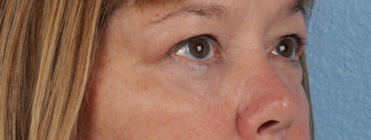 Pigment Laser Before & After Gallery - Patient 407755 - Image 6