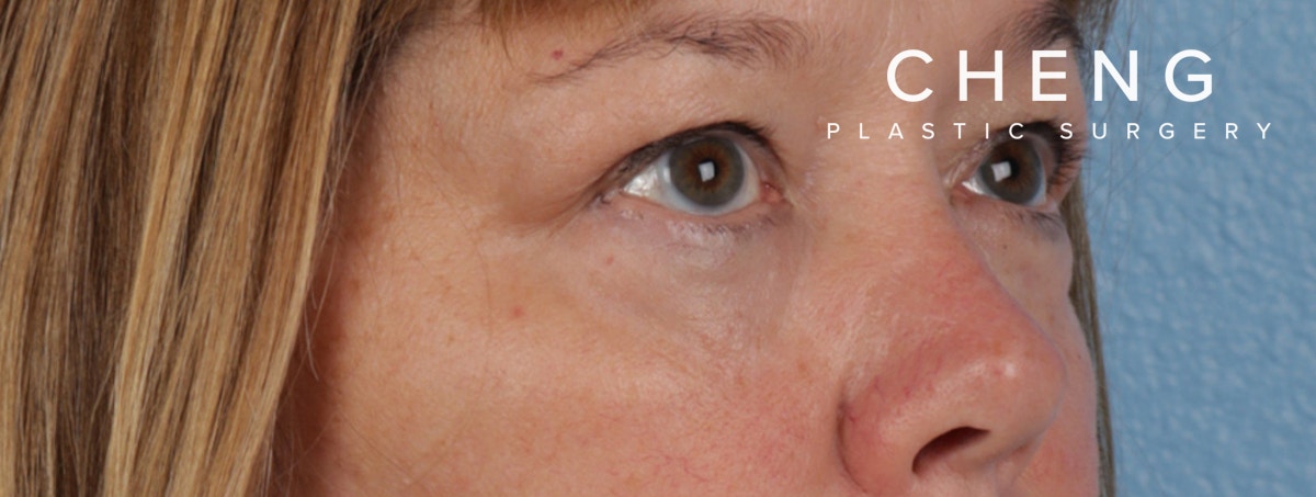 Hidden Patients Before & After Gallery - Patient 385354 - Image 6