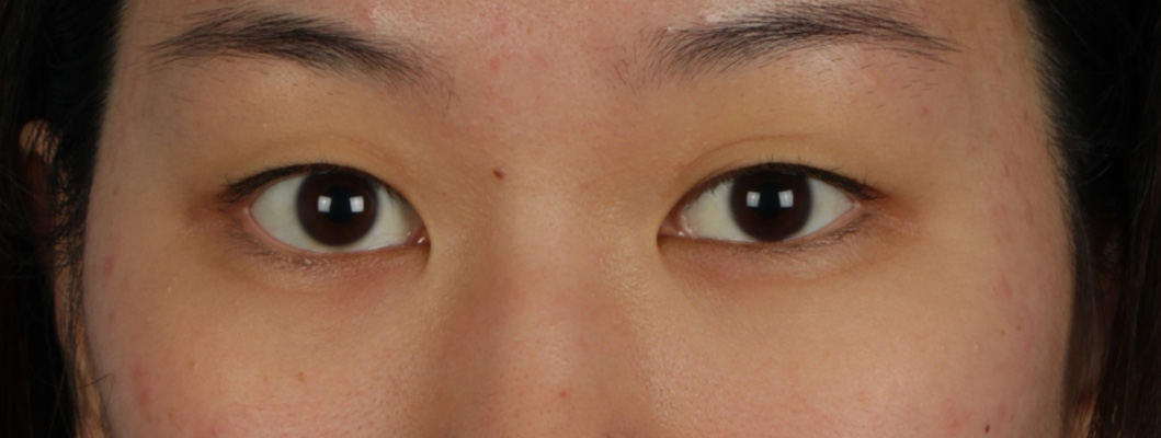 Blepharoplasty Before & After Gallery - Patient 407537 - Image 1