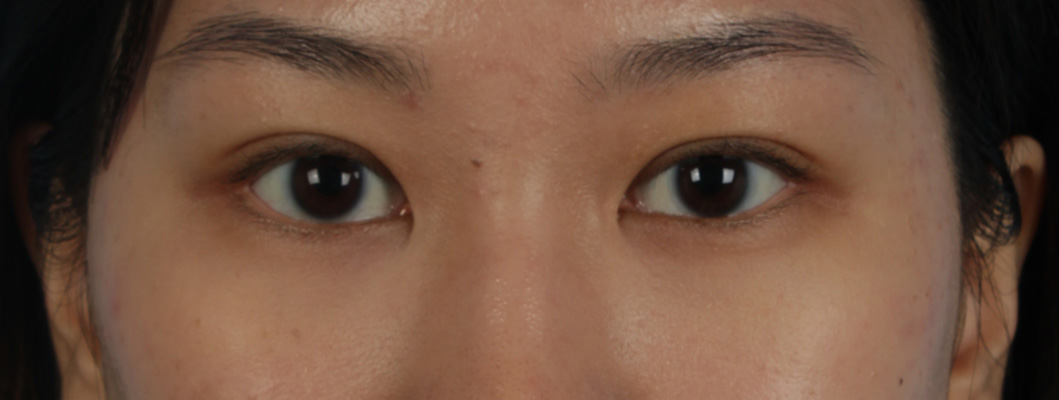 Blepharoplasty Before & After Gallery - Patient 407537 - Image 2