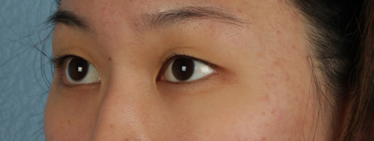 Blepharoplasty Before & After Gallery - Patient 407537 - Image 3