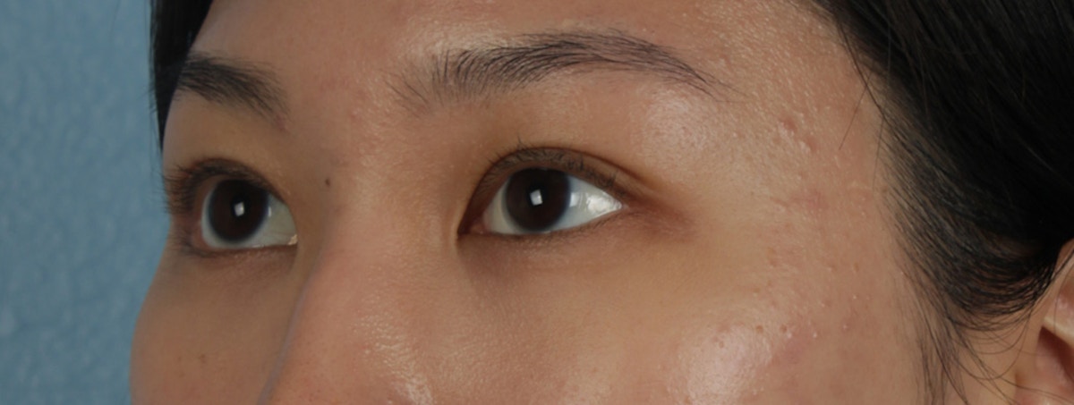 Blepharoplasty Before & After Gallery - Patient 407537 - Image 4