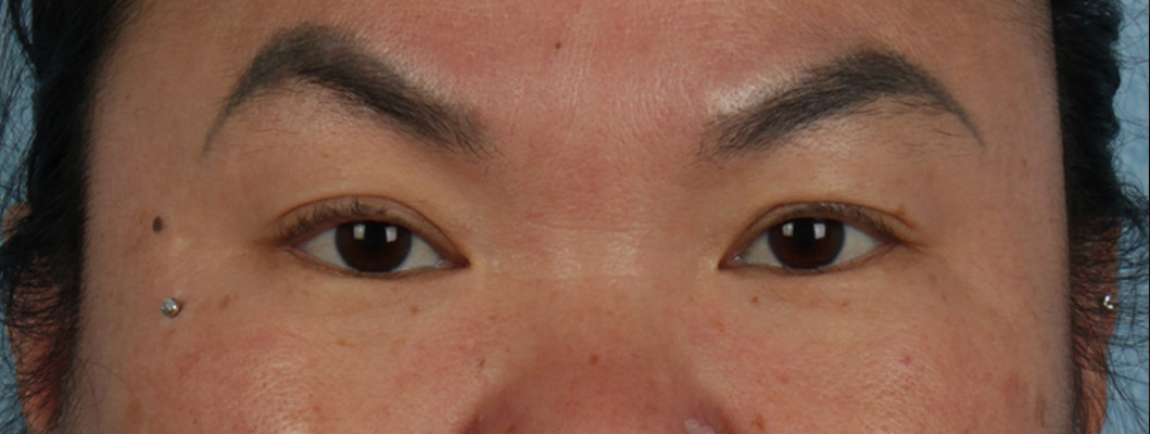 Hidden Patients Before & After Gallery - Patient 873403 - Image 1