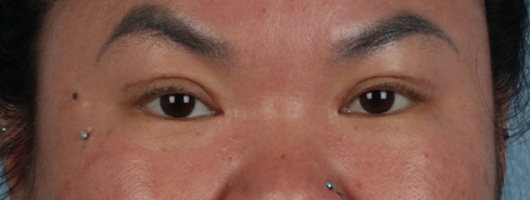 Hidden Patients Before & After Gallery - Patient 873403 - Image 2