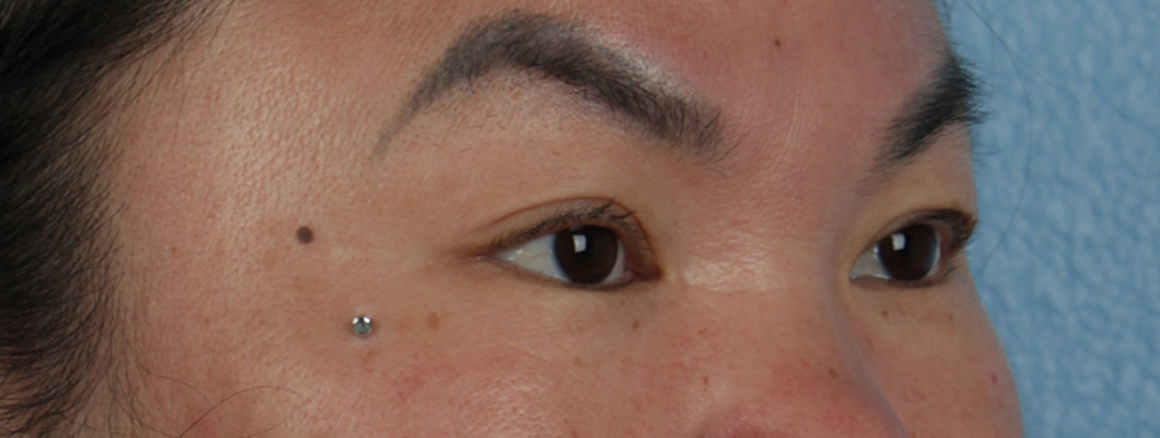 Hidden Patients Before & After Gallery - Patient 873403 - Image 3