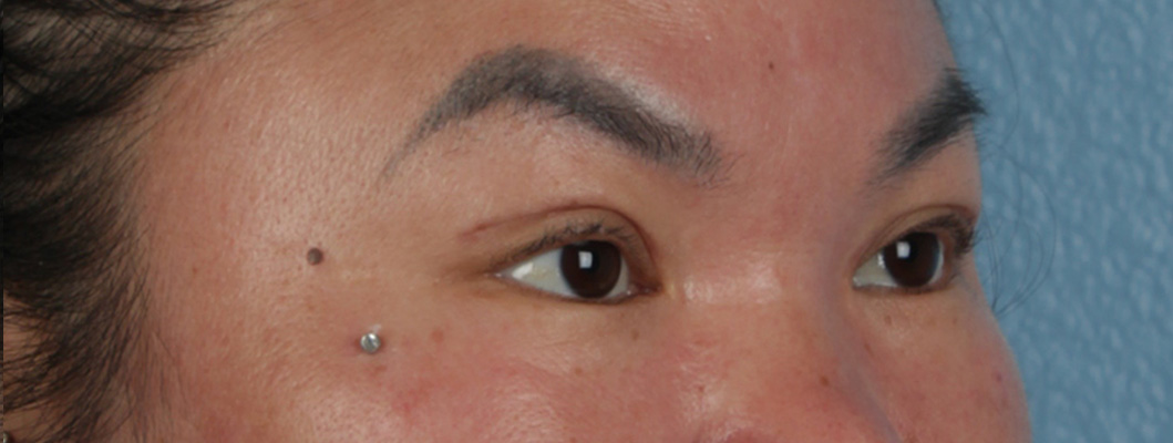 Hidden Patients Before & After Gallery - Patient 873403 - Image 4