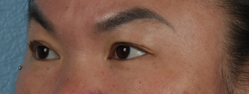 Hidden Patients Before & After Gallery - Patient 873403 - Image 5