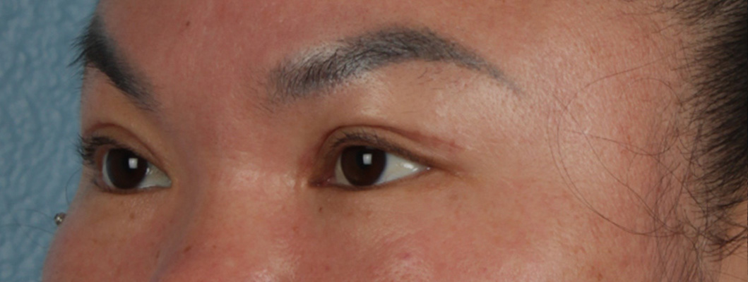 Hidden Patients Before & After Gallery - Patient 873403 - Image 6