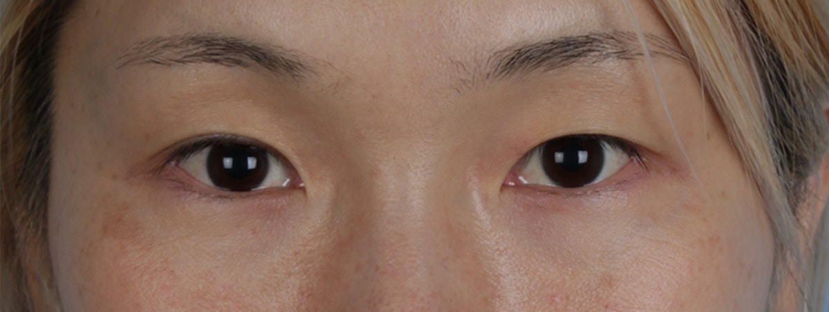 Blepharoplasty Before & After Gallery - Patient 309409 - Image 1