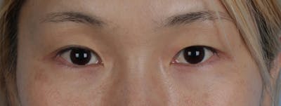 Blepharoplasty Before & After Gallery - Patient 309409 - Image 1